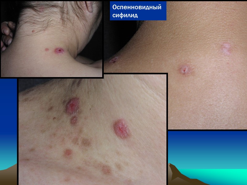 Оспенновидный сифилид